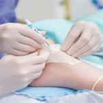 Placental Allografts.